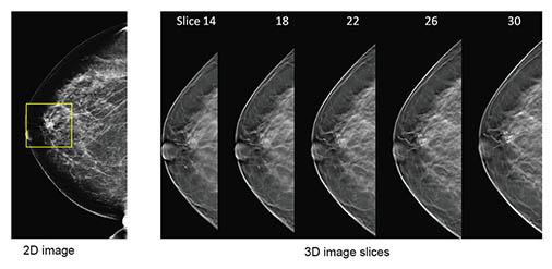 2d vs 3d mammography comparison.