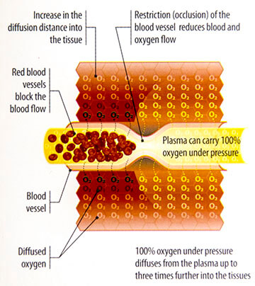 Hyperbaric Oygen Therapy oygentation graphic