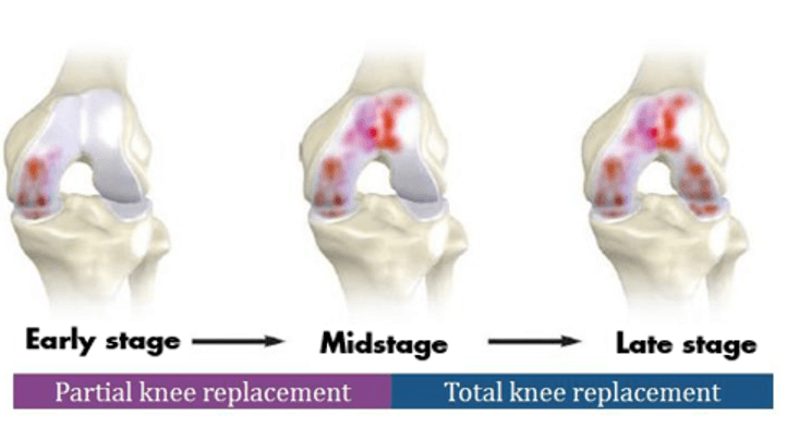 Illustration showing partial knee replacement vs total knee replacement.